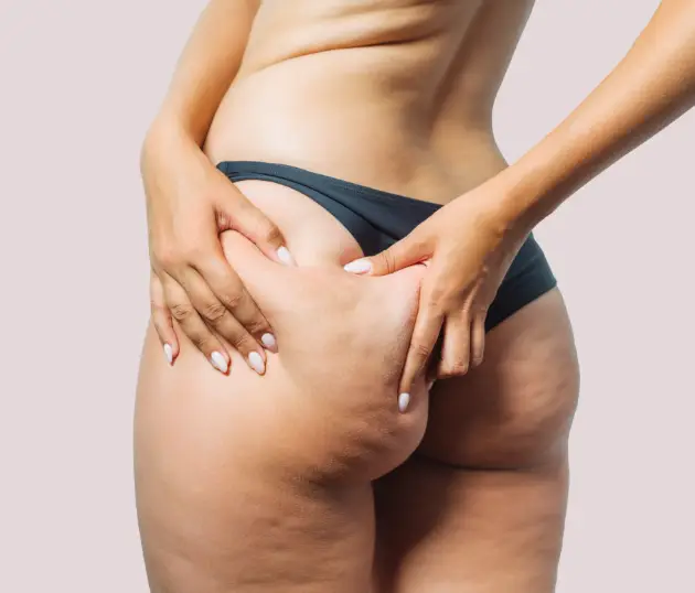 View of a woman's lower back and glutes, representing body concerns like cellulite and stretch marks.