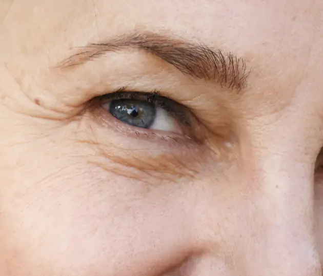 Under-Eye Sagging Eye Bags and Crow's Feet - Medford & Braintree