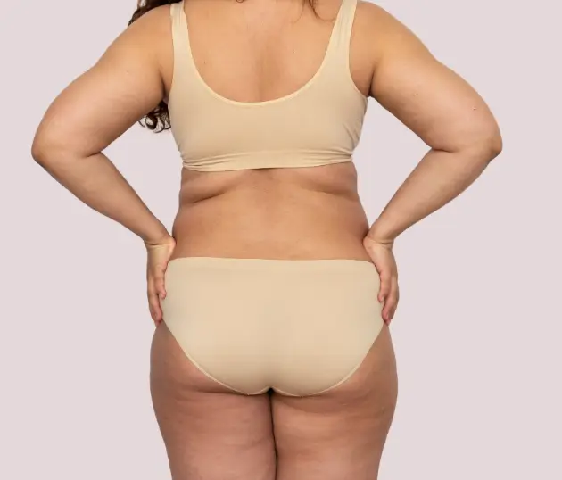 Rear view of a woman’s torso showing localized fat deposits on the back and hips.