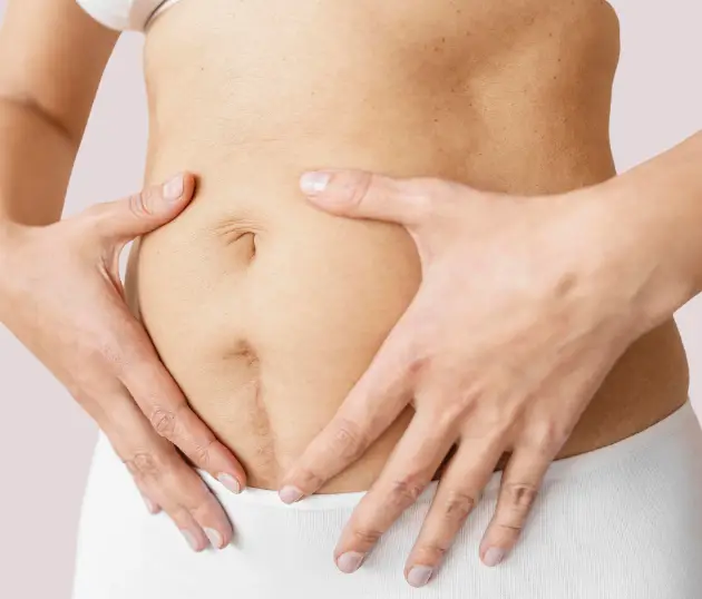 Front view of a woman's abdomen showing post-pregnancy skin changes and a visible linea nigra.