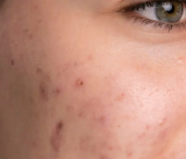 Close-up of skin with active acne breakouts and visible post-inflammatory acne scarring.