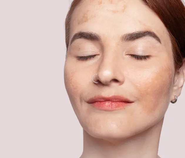 Close-up of a woman’s face with visible melasma and dark pigmentation spots on the forehead and cheeks.