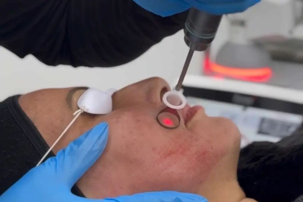 A provider performs a facial laser treatment.