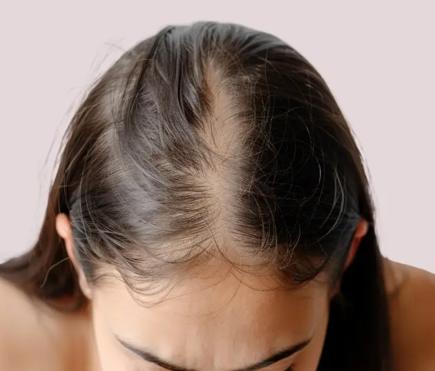Close-up of a woman's scalp with visible thinning at the part, illustrating female pattern hair loss.