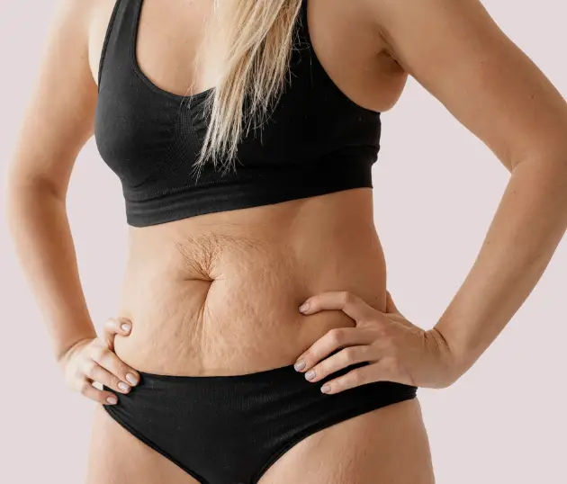 Side view of a woman's midsection showing skin laxity and visible stretch marks on the abdomen.
